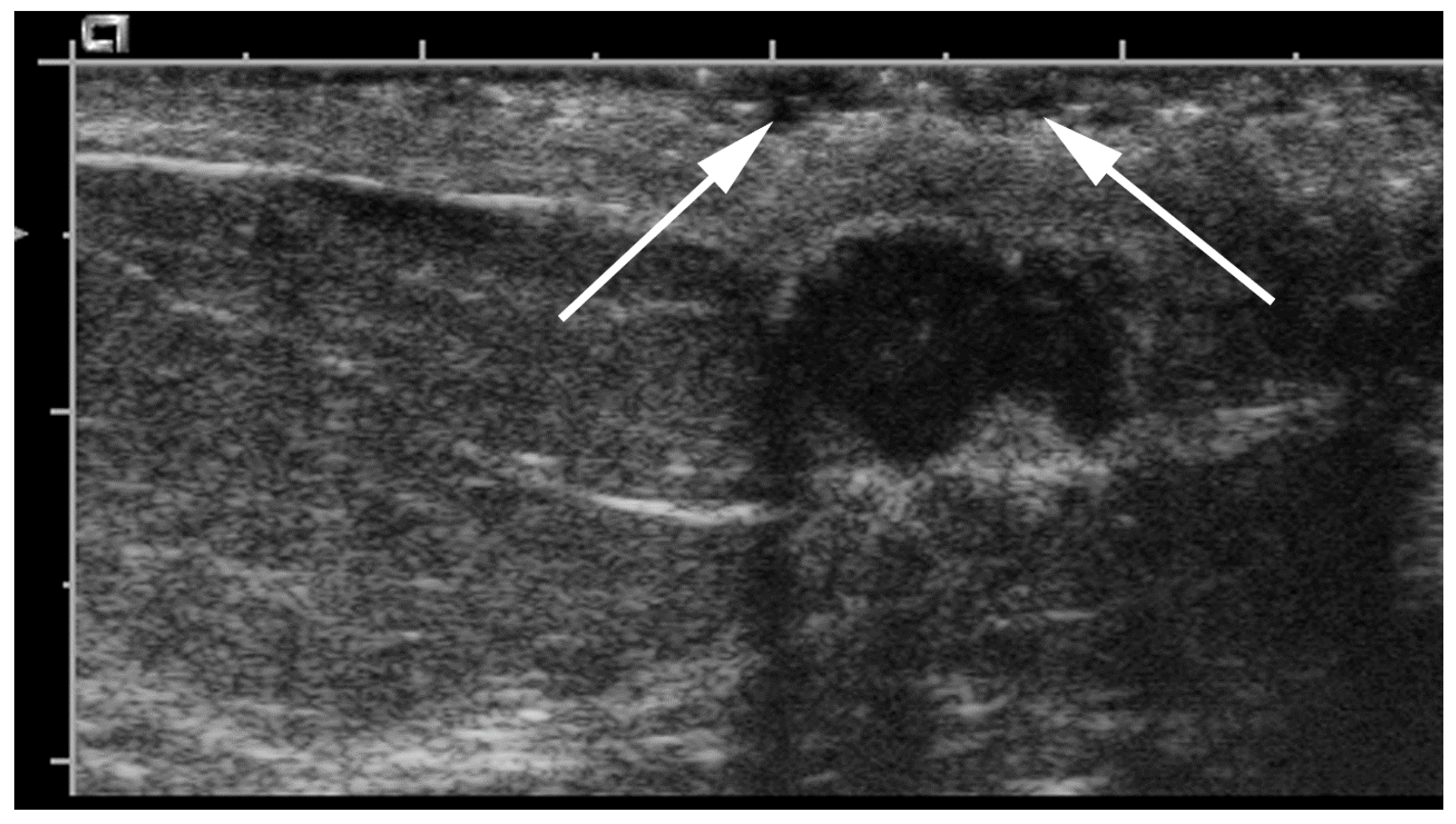 Cancers Free Full Text Retroareolar Carcinomas In Breast Ultrasound