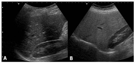 Children | Special Issue : Pediatric Nonalcoholic Fatty Liver Disease