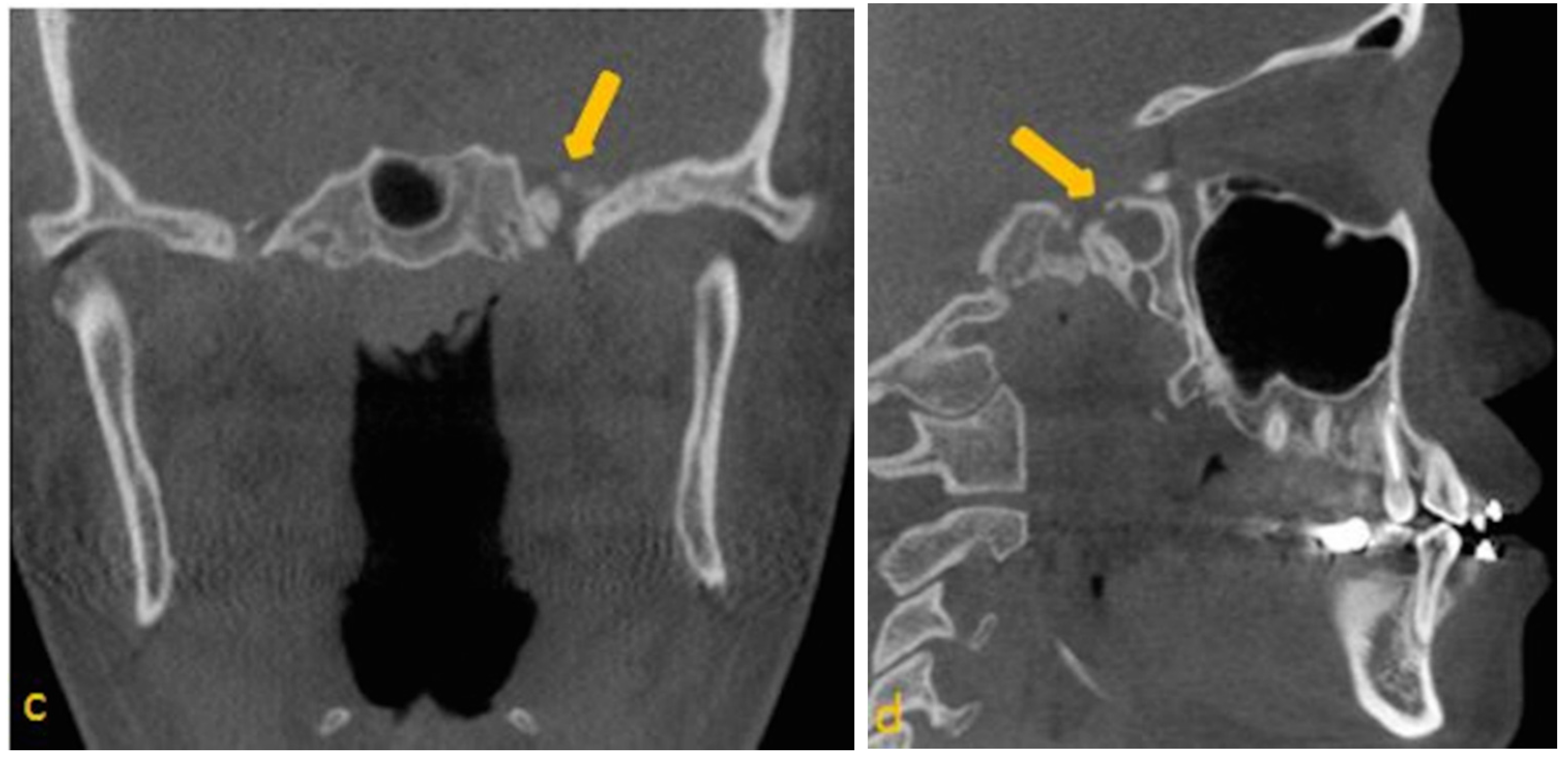 dentistry journal free full text arrested palatine bone