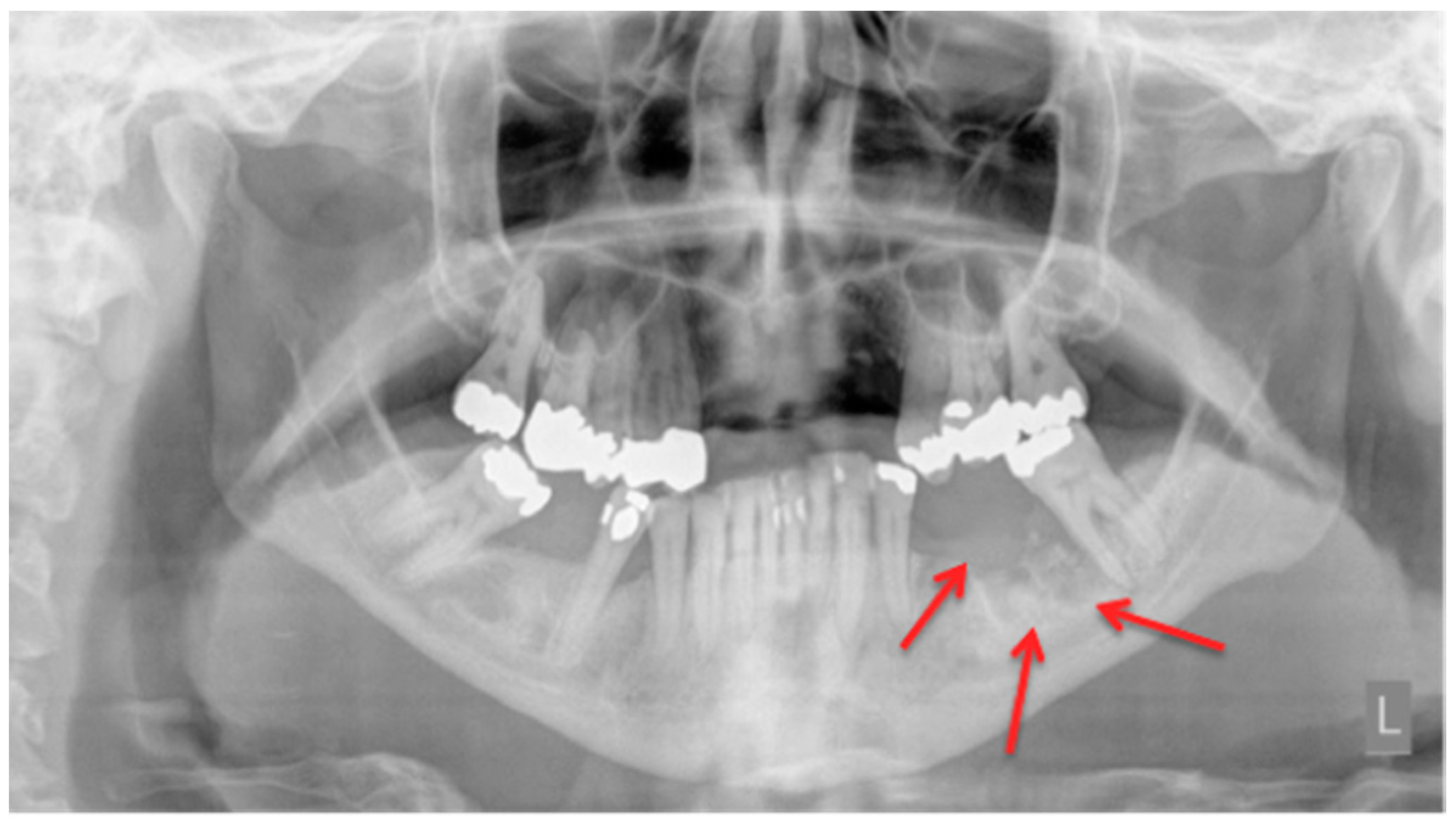 how does fosamax affect the jaw