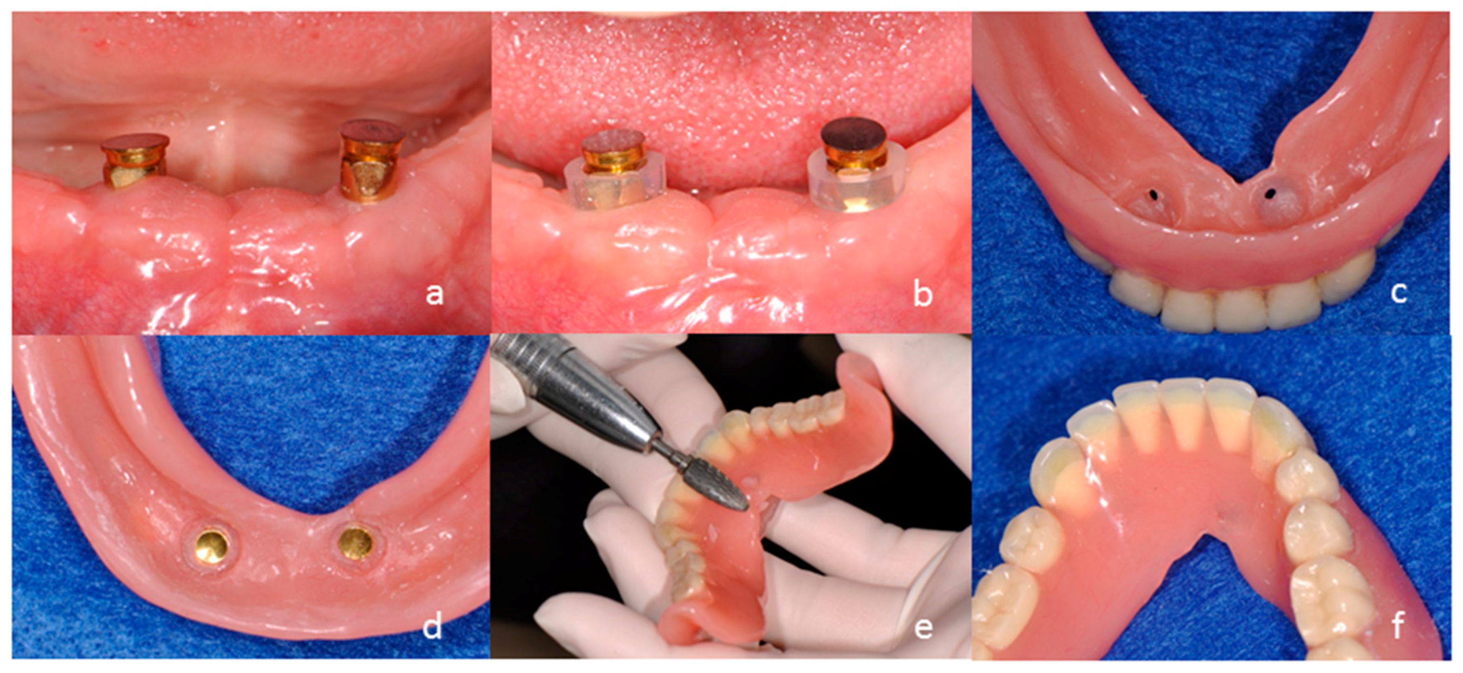 overdenture