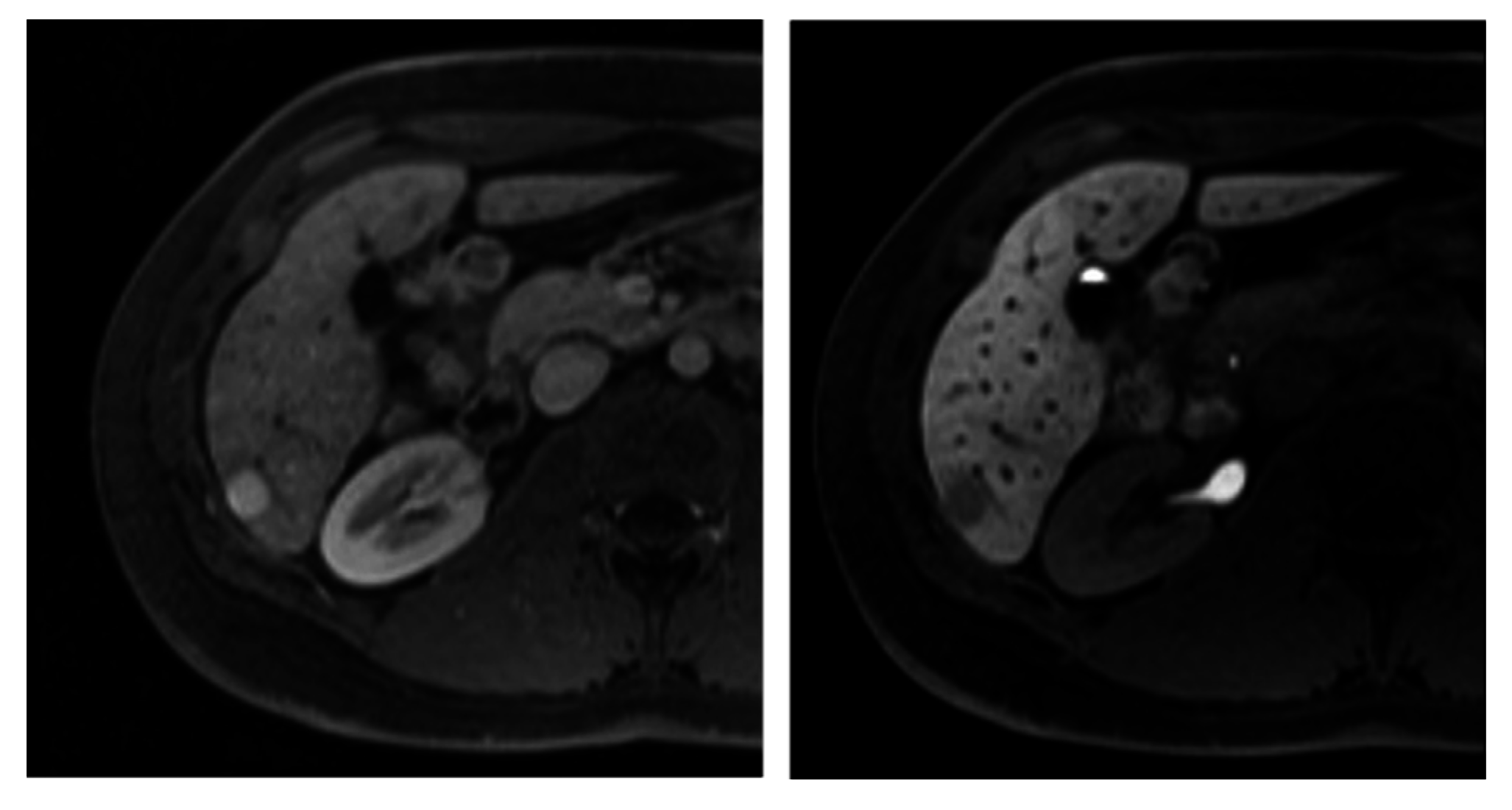 tumor dikke darm kwaadaardig
