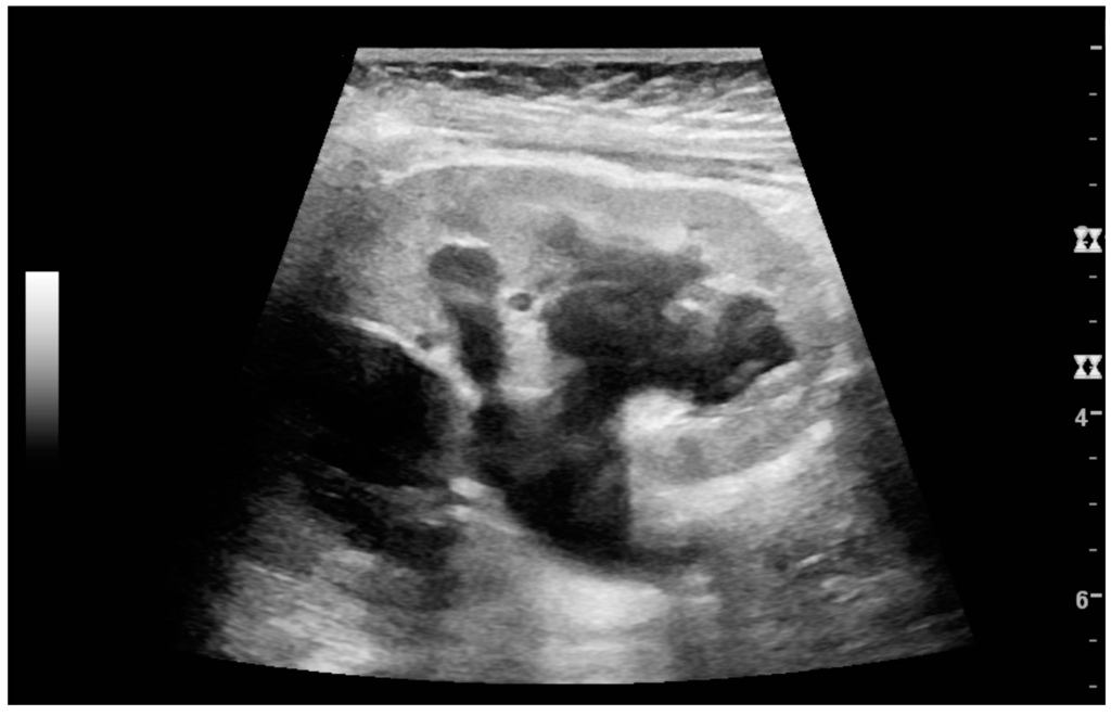 Simply upj obstruction adults That can upj obstruction adults thought
