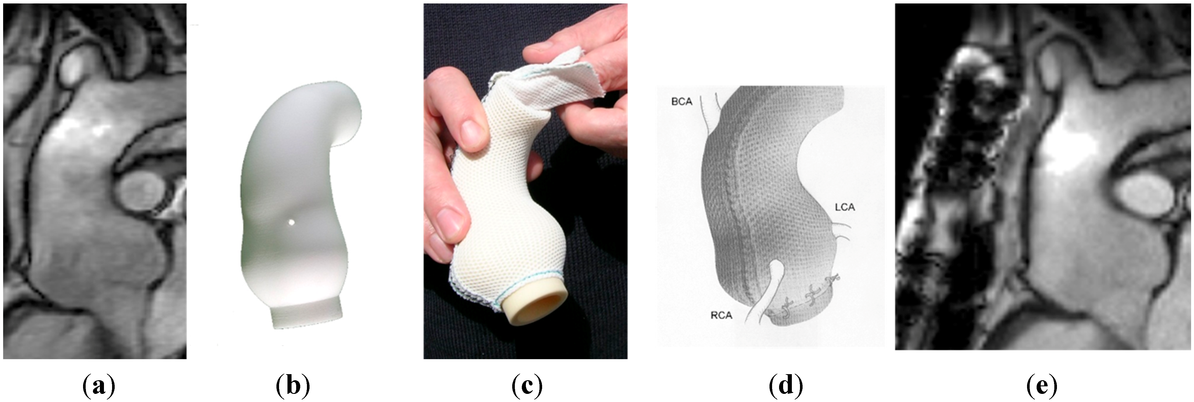 Diseases Free FullText Personalised External Aortic Root Support