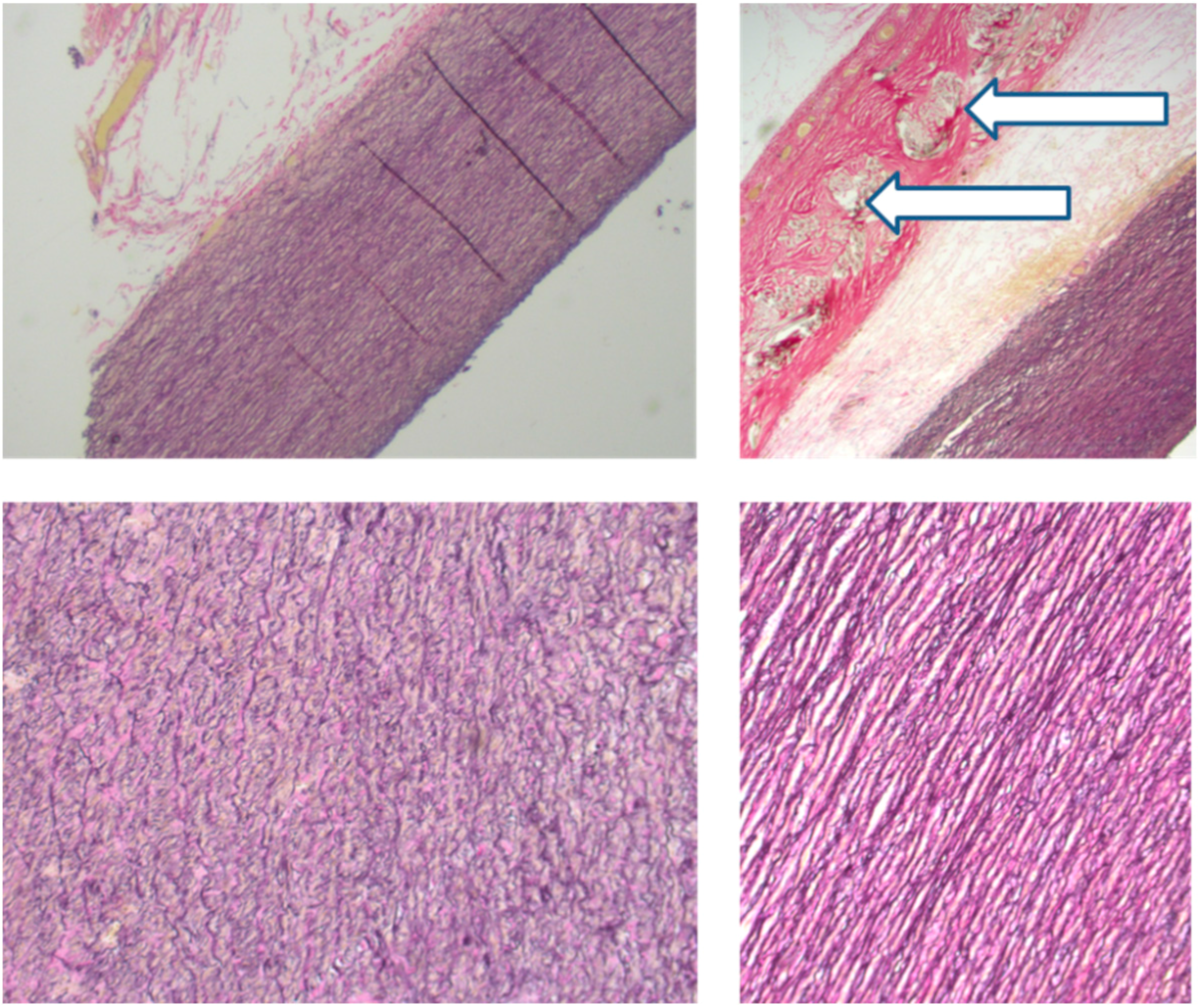 Diseases Free FullText Personalised External Aortic Root Support