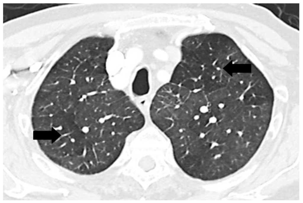 Diseases Free FullText Mosaic Pattern of Lung Attenuation on Chest