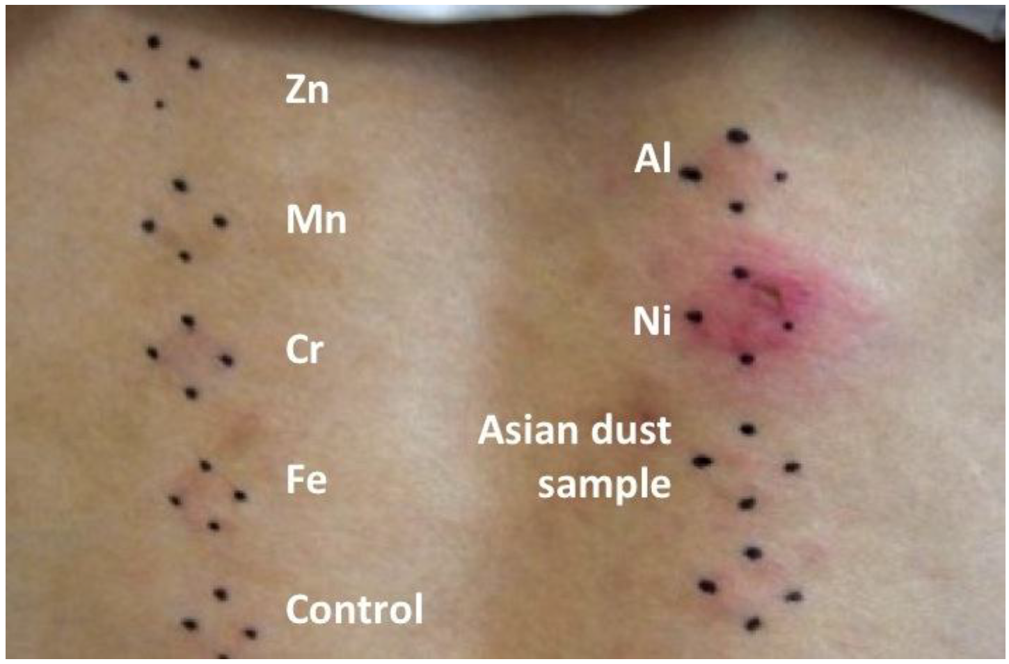 allergic skin symptoms dust ijerph reactions asian