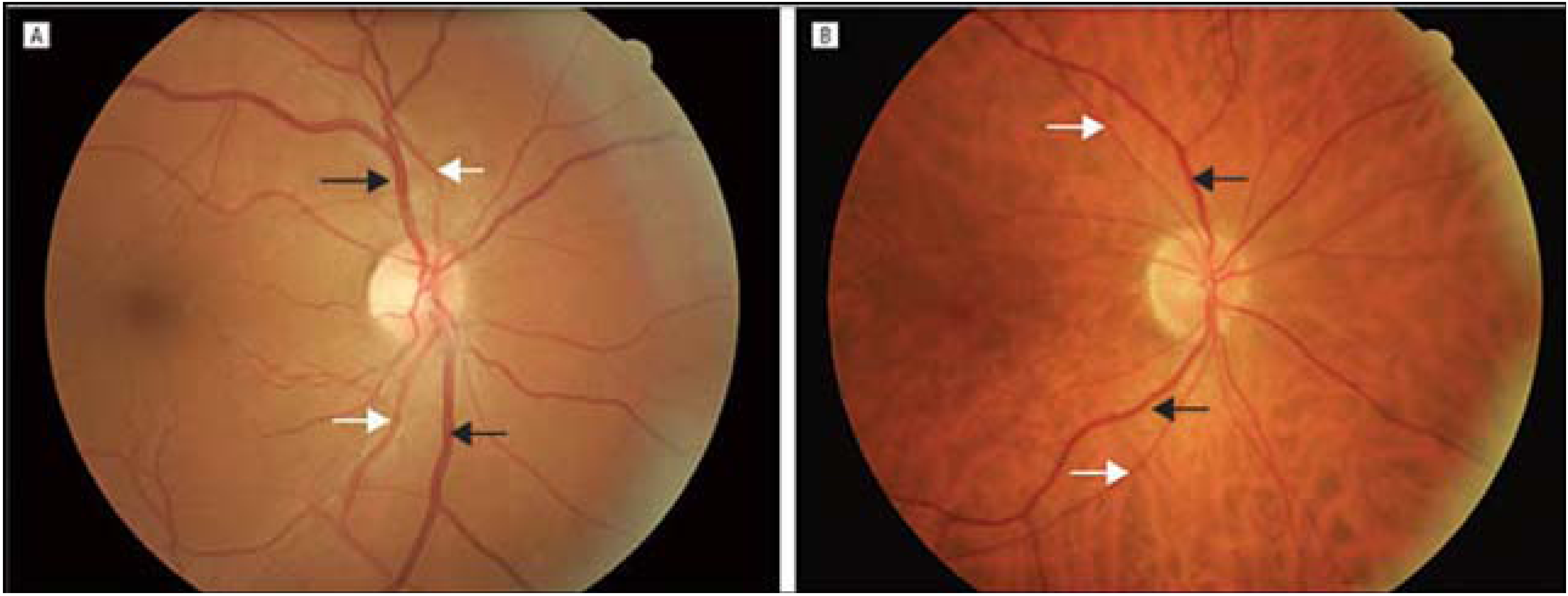 IJERPH | Free Full-Text | Relationship between Retinal Vascular Caliber