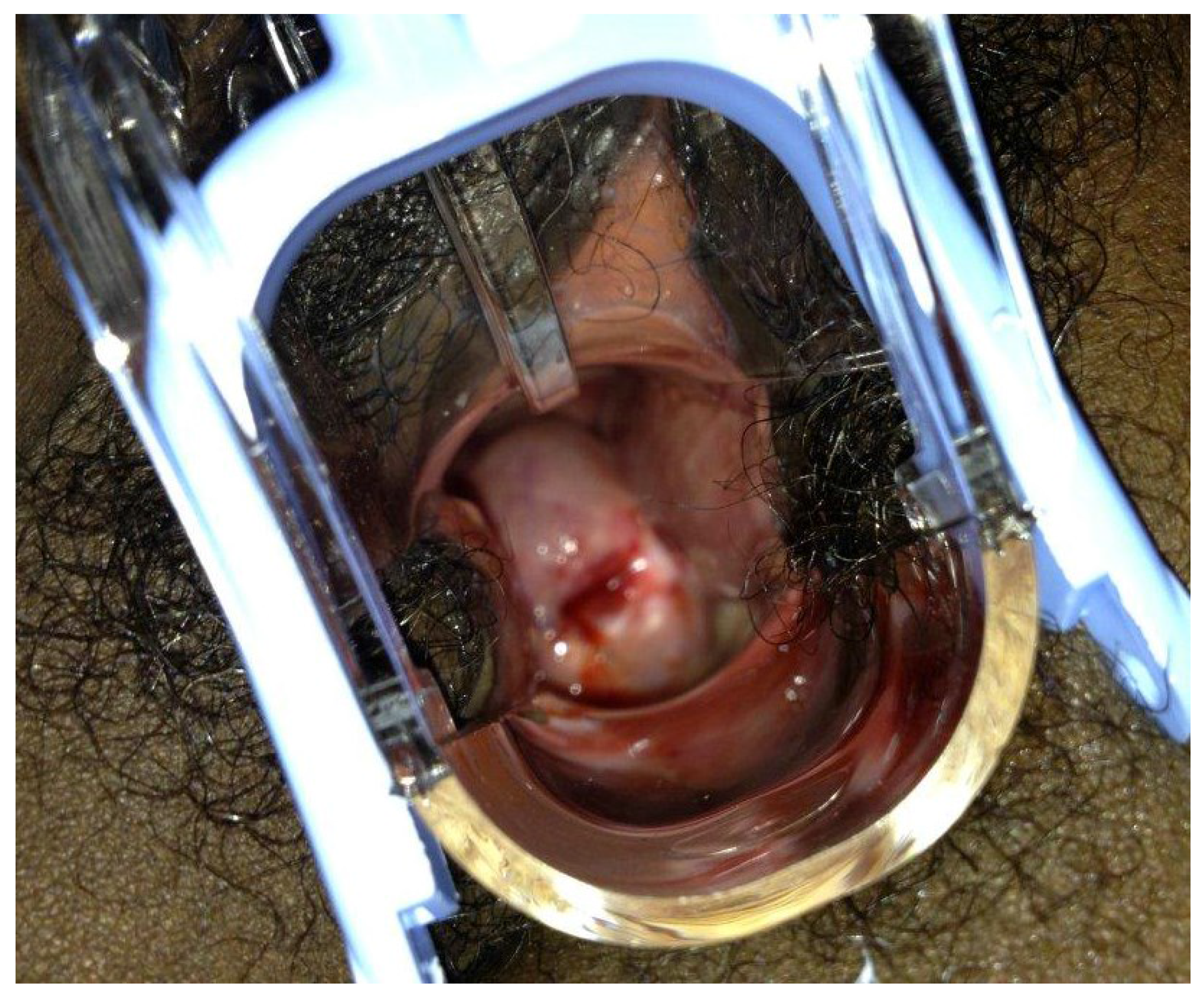 Inspection of breast cancer 5