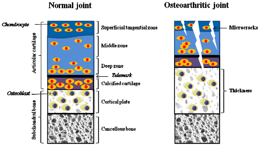 Image result for subchondral bone cartilage