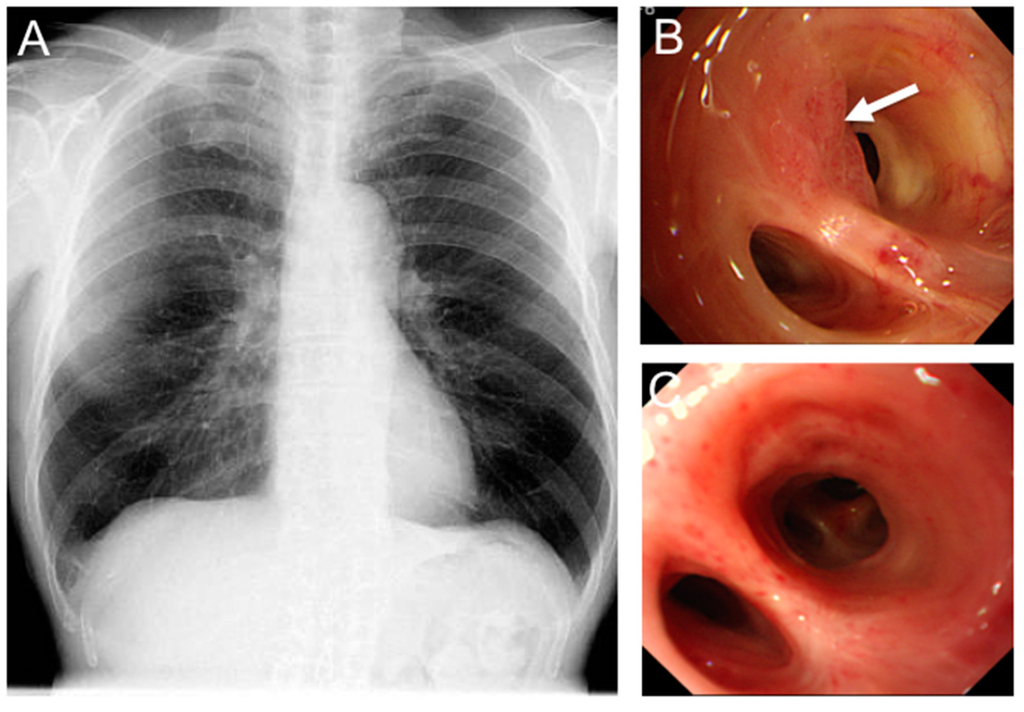 lung cancer level four survivors