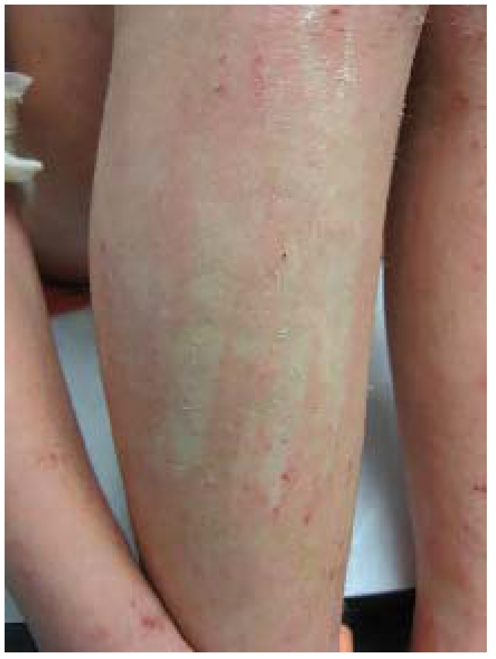 JCM Special Issue Epidemiology and Treatment of Atopic Eczema