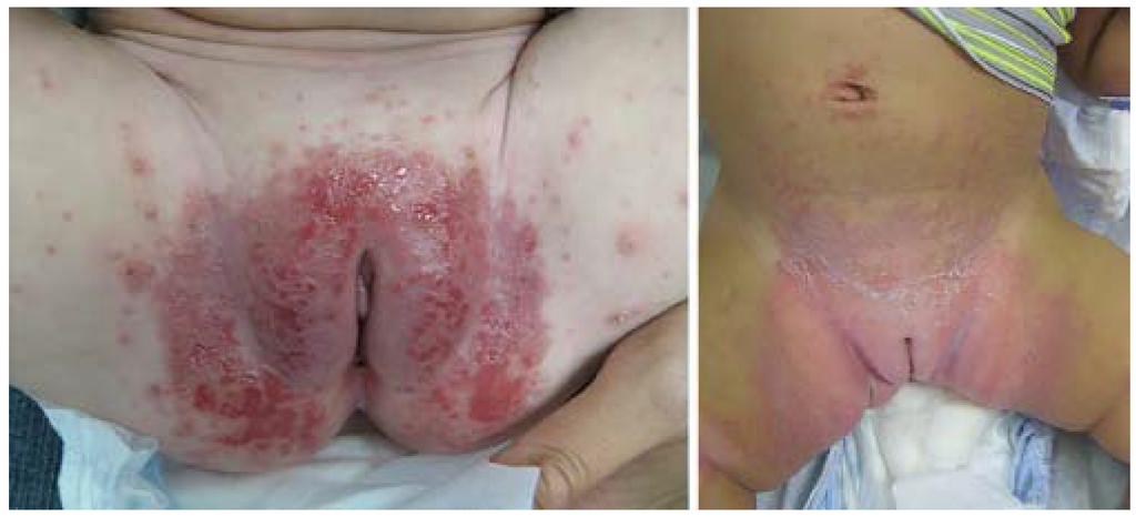 tinea infections #11