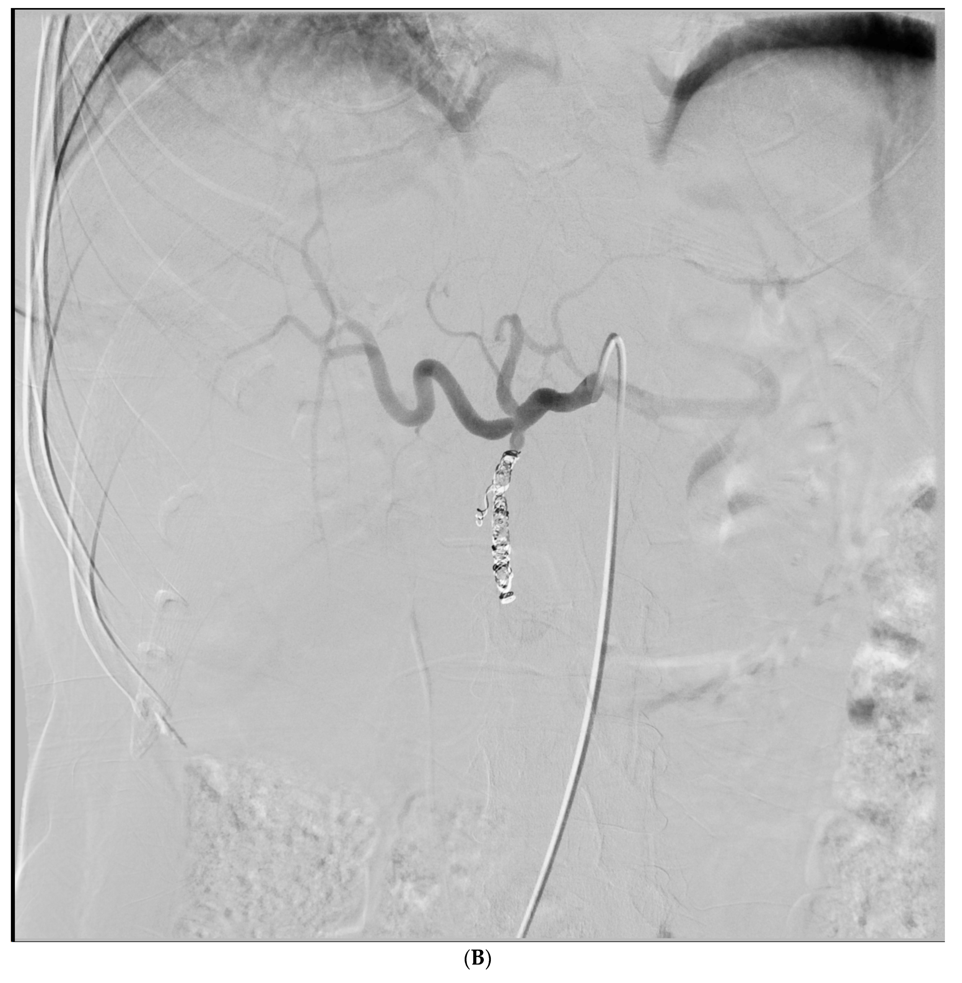 JCM Free FullText Gastrodoudenal Embolization Indications