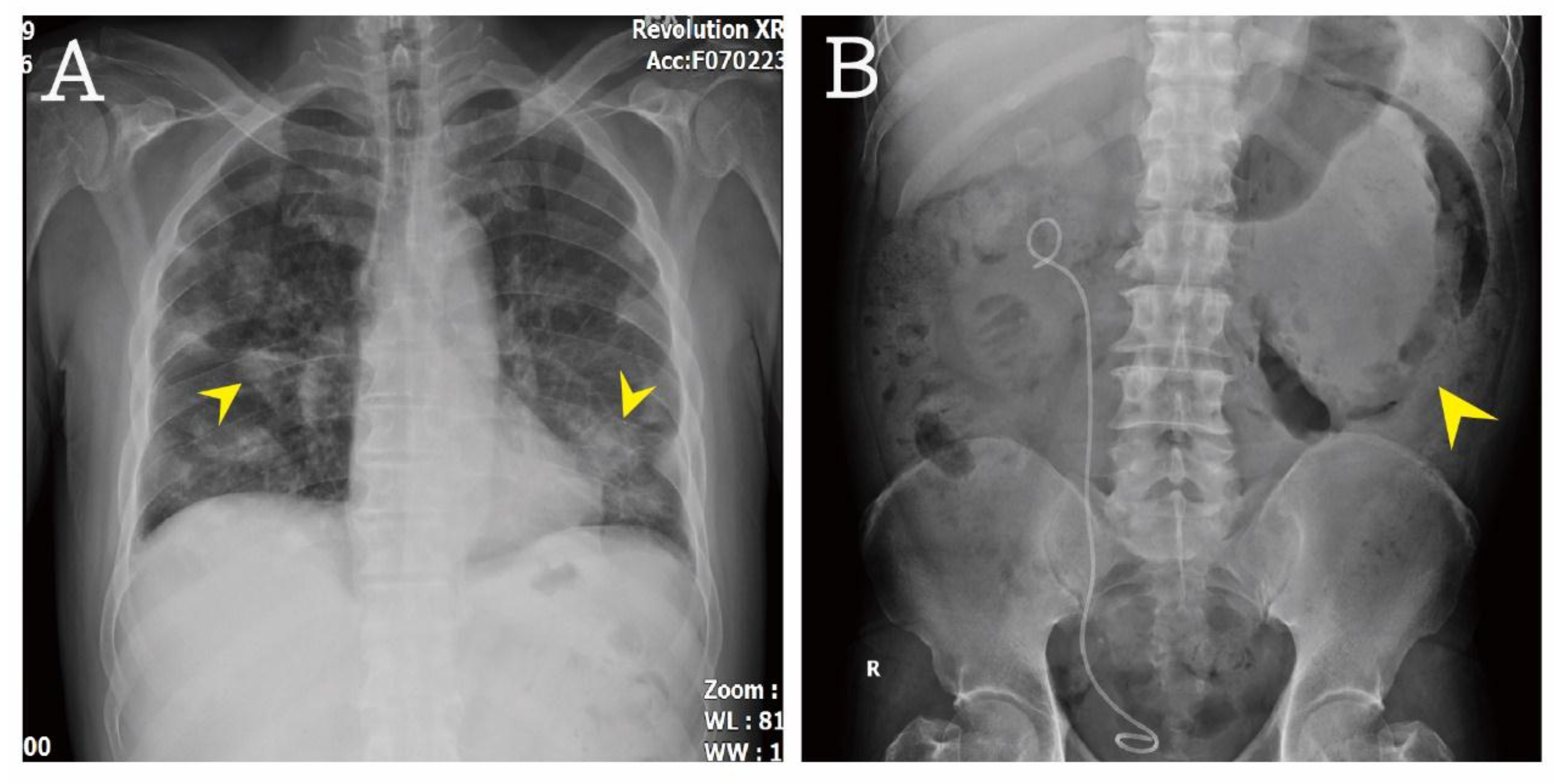 jcm free full text septic pulmonary emboli or jcm free full text septic pulmonary emboli or