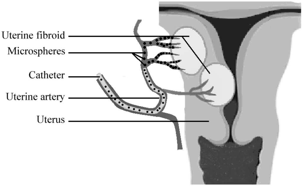 Can You Treat Fibroids Naturally Can You Treat Fibroids Naturally