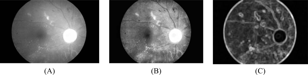 undergraduate student thesis exudate detection retinal images undergraduate student thesis exudate detection retinal images