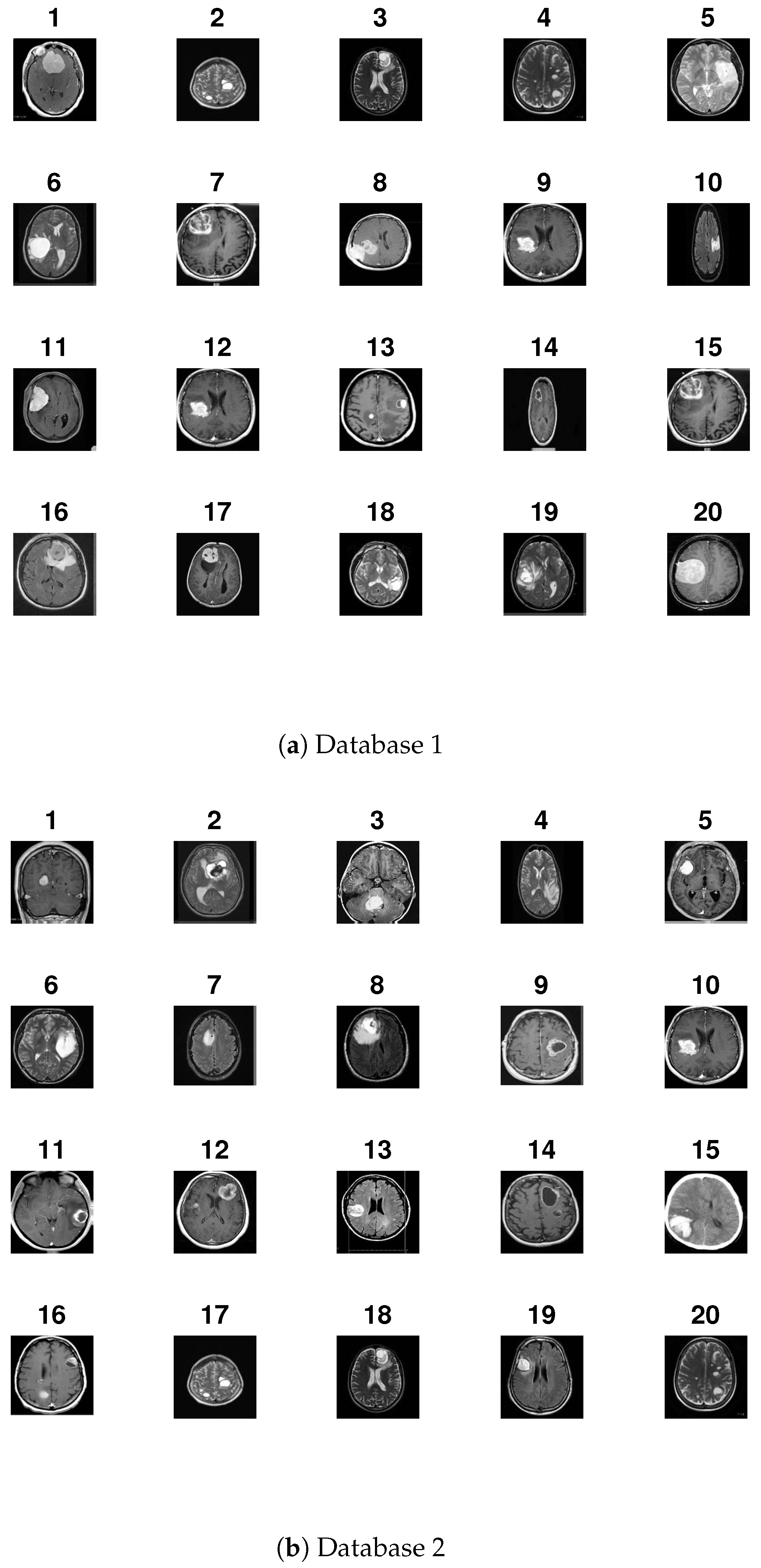 Automatic Human Brain Tumor Detection in MRI Image Using Template-Based ...