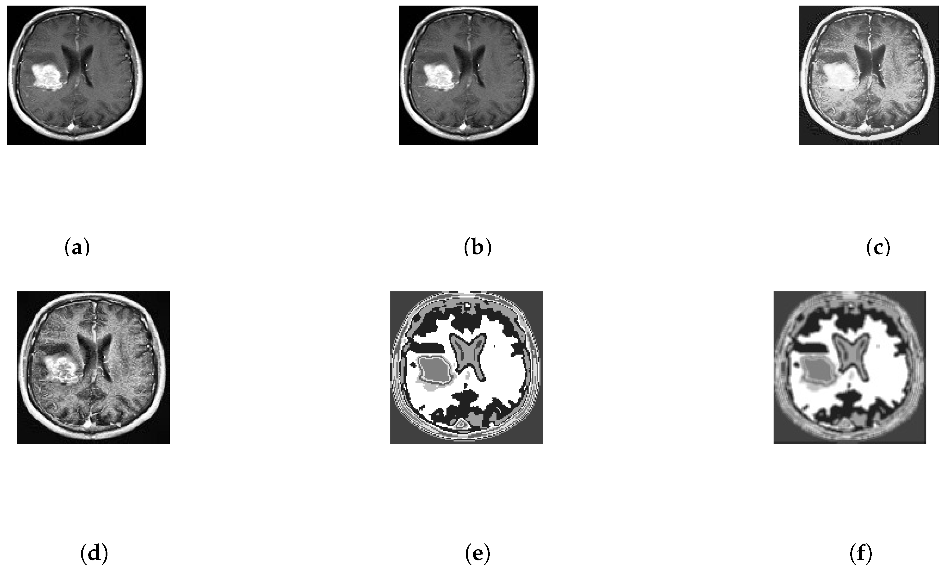 Automatic Human Brain Tumor Detection in MRI Image Using Template-Based ...