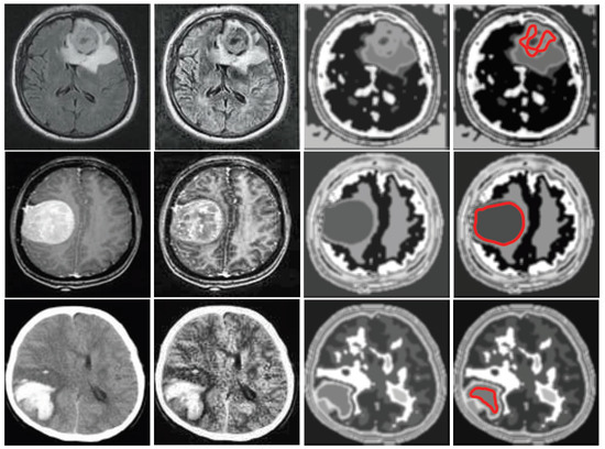 Automatic Human Brain Tumor Detection in MRI Image Using Template-Based ...
