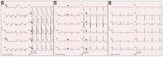 Time-Dependent ECG Modifications in Pheochromocytoma-Induced Cardiomyopathy. From left to right: (A) ECG on admission showing sinus tachycardia with anterolateral ST-segment elevation (arrows). (B) ECG obtained the following day after initiation of combined alpha- and beta-blockade therapy, demonstrating T-wave inversion (arrowheads) and significant QT interval prolongation (QT 520 ms, QTc 570 ms). (C) Postoperative ECG after adrenalectomy showing normalization of repolarization parameters (QT 430 ms, QTc 440 ms).