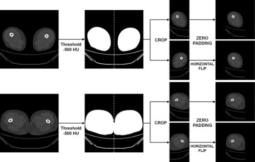 Pre-processing pipeline for thigh computed tomography (CT) images. Thresholding at −500 Hounsfield units (HU) was applied to create a binary mask separating air from other regions. The bilateral thighs were automatically identified, cropped, zero-padded to a uniform size, and horizontally flipped for data augmentation.