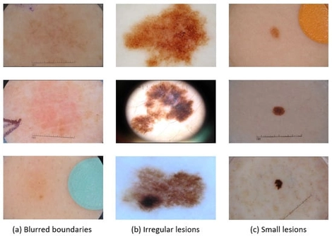 Some representative images from the ISIC2018 dataset.
