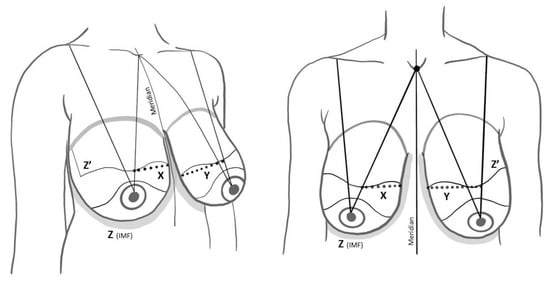 Z is the inframammary fold. Z’ is the new breast pocket. X is from the meridian to the medial triangle. Y is the meridian to the lateral triangle.