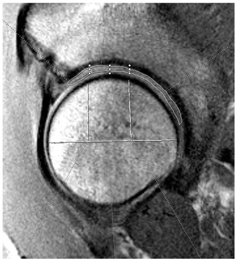 Example of acetabular cartilage T2 mapping on a sagittal MRI. The measurements were divided into three zones (anterior, superior, and posterior). The horizontal white line bisects the femoral head, and the vertical lines split the joint surface into 3 zones: anterior (left), superior (middle), and posterior (right). The three zones on the acetabular cartilage are drawn by free-hand technique based on these divisions.