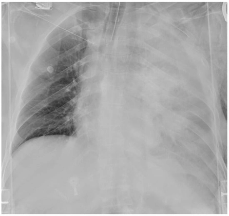 Admission chest film showing massive left hemothorax.
