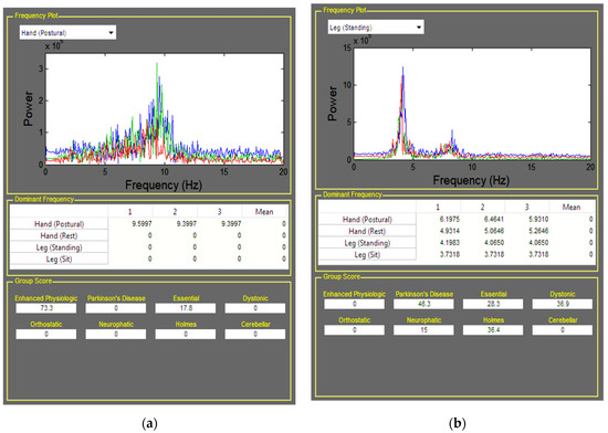 Actuators | Free Full-Text | A Portable Non-Contact Tremor Vibration Measurement and Classification Apparatus