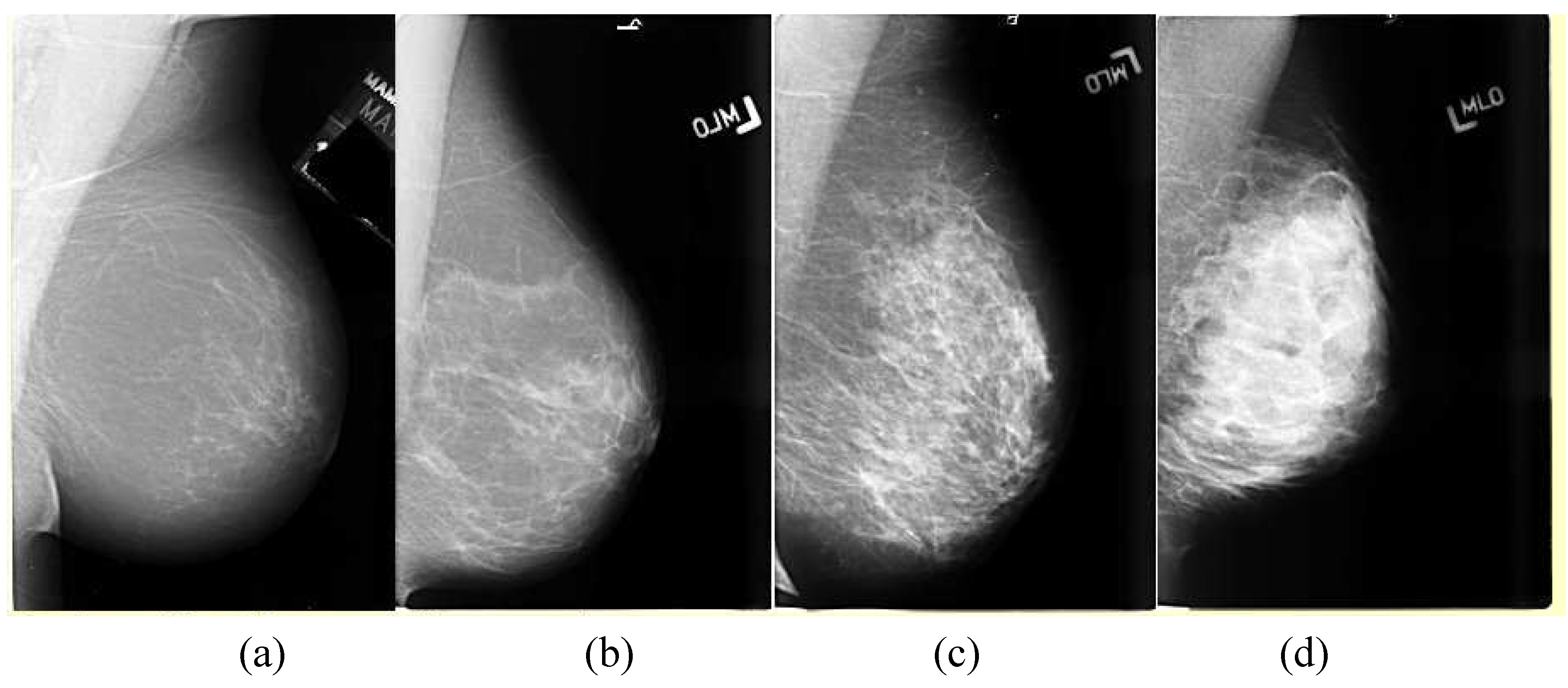 Диффузная мастопатия bi rads 2. 2 Тип строения по ACR маммография. Фиброзная мастопатия маммограмма. Рентгенологическая маммография. Фиброзно-кистозная мастопатия маммография bi-rads.