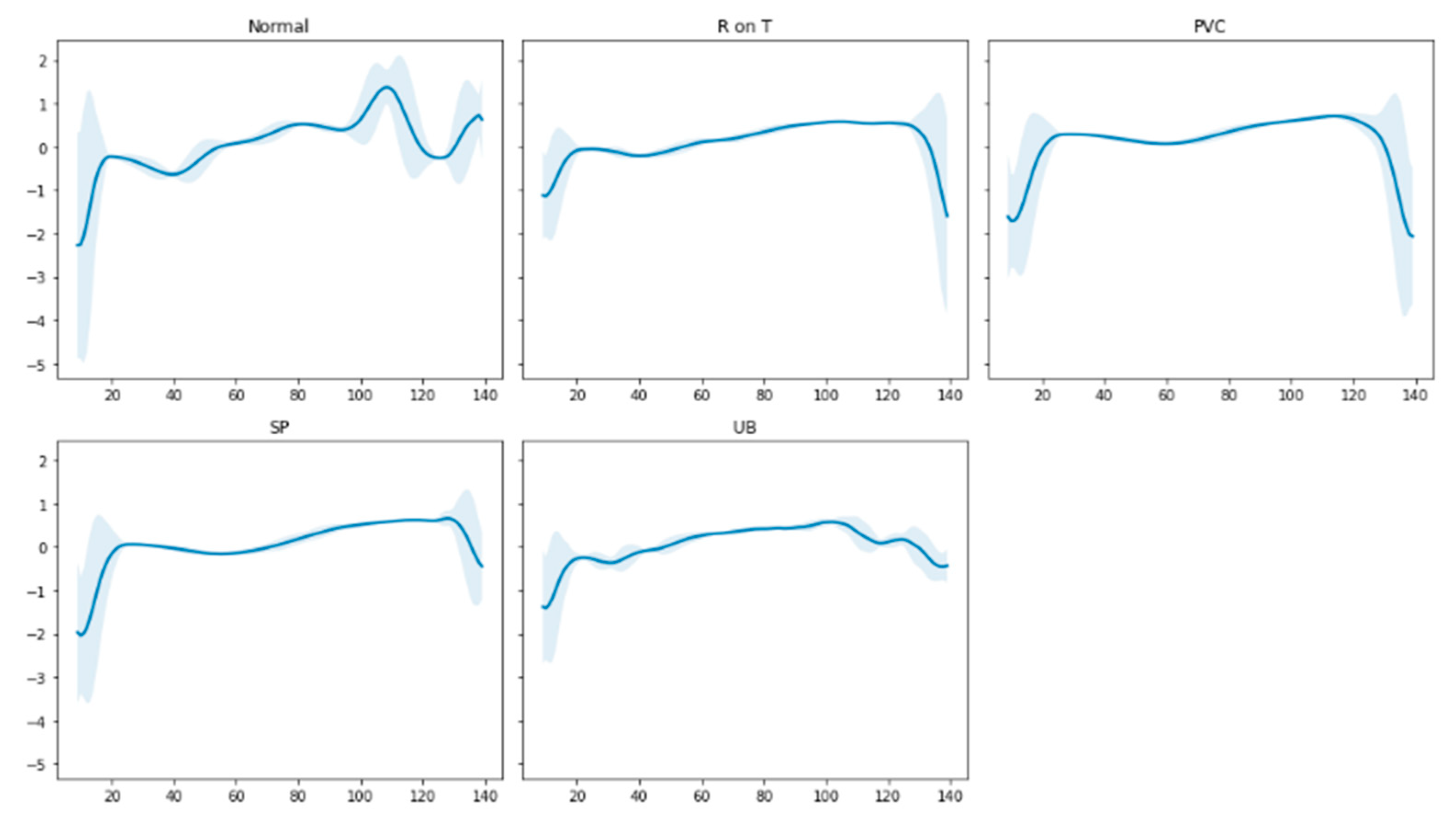 Unsupervised Transformer-Based Anomaly Detection in ECG Signals