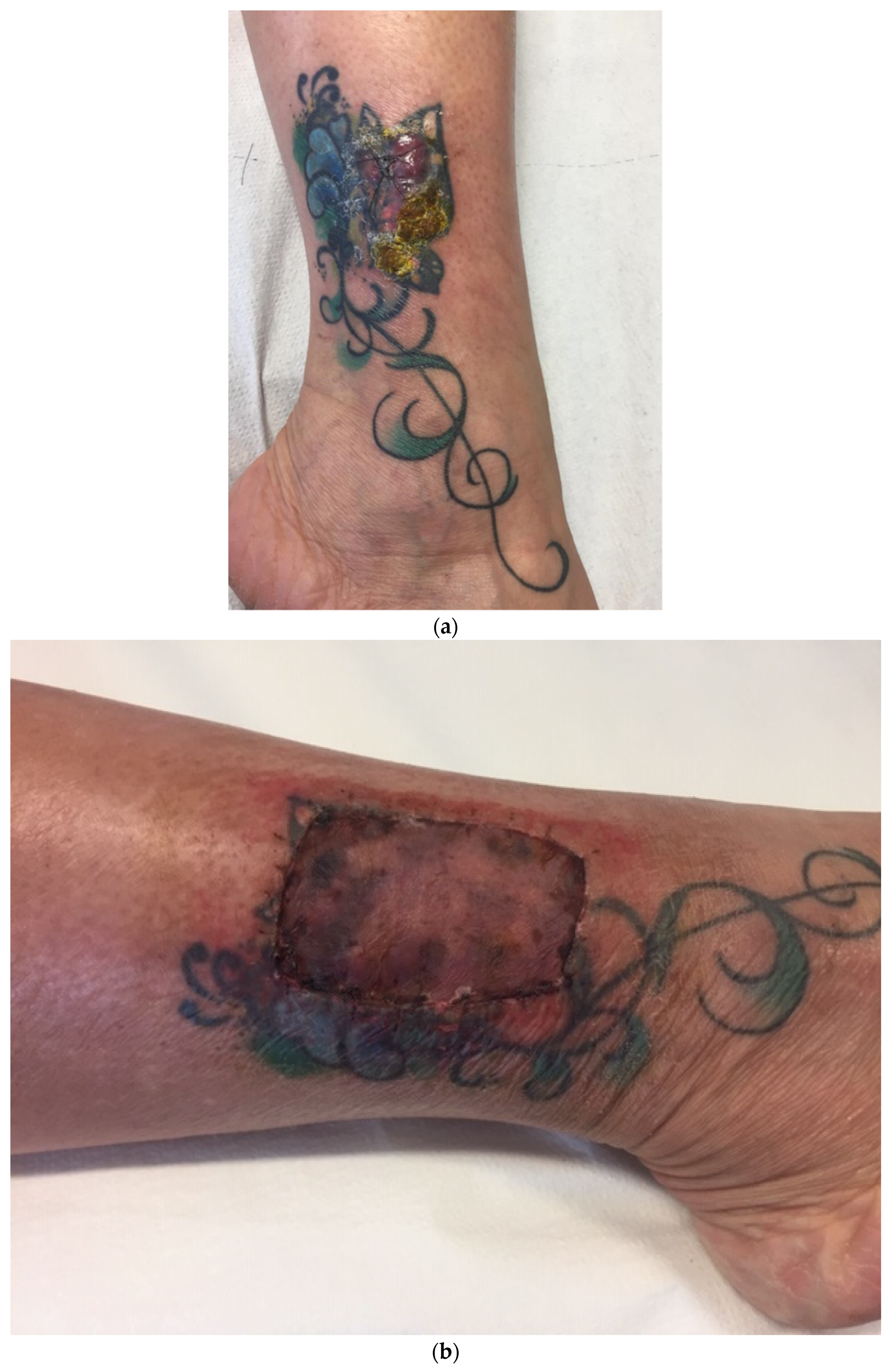 Allergies | Free Full-Text | A Peculiar Case of Allergic Granulomatous Reaction to Red Pigment: A Tattoo Touch-Up Treated Surgically Allergies | Free Full-Text | A Peculiar Case of Allergic Granulomatous Reaction to Red Pigment: A Tattoo Touch-Up Treated Surgically