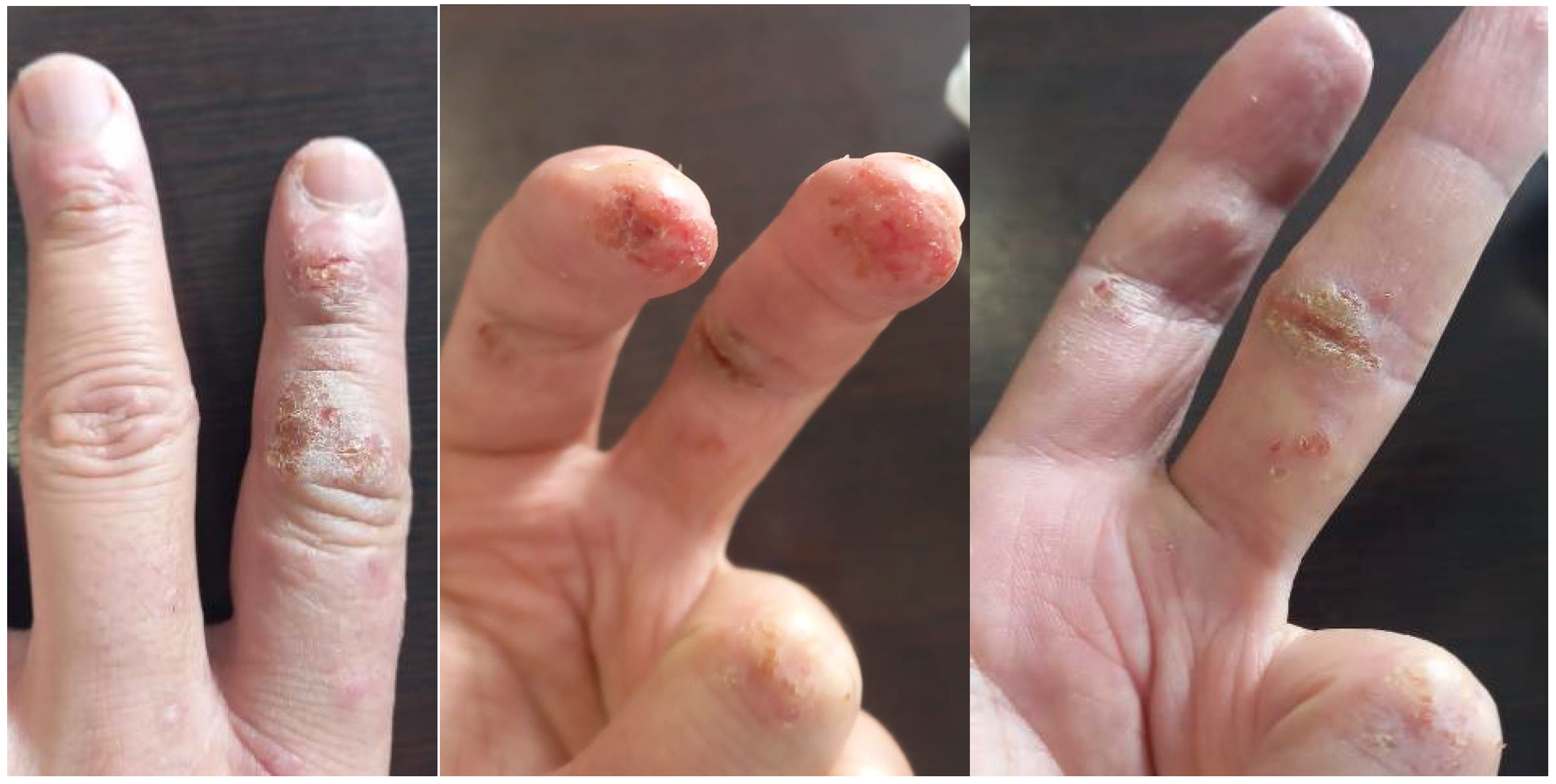 Allergies Free FullText Occupational Dermatitis Treated with