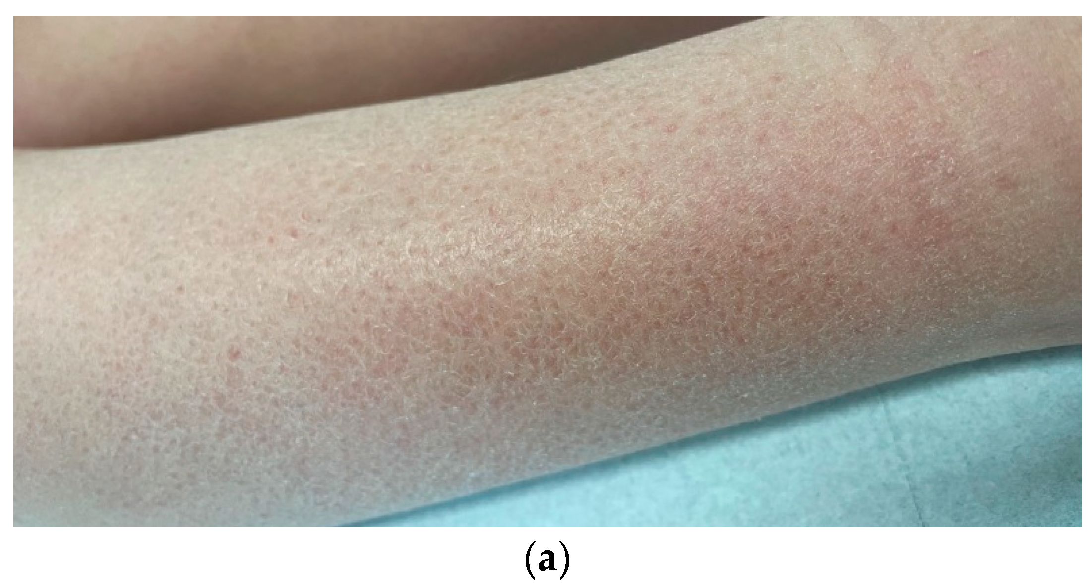 Allergies 02 00009 g002a Allergies 02 00009 g002a