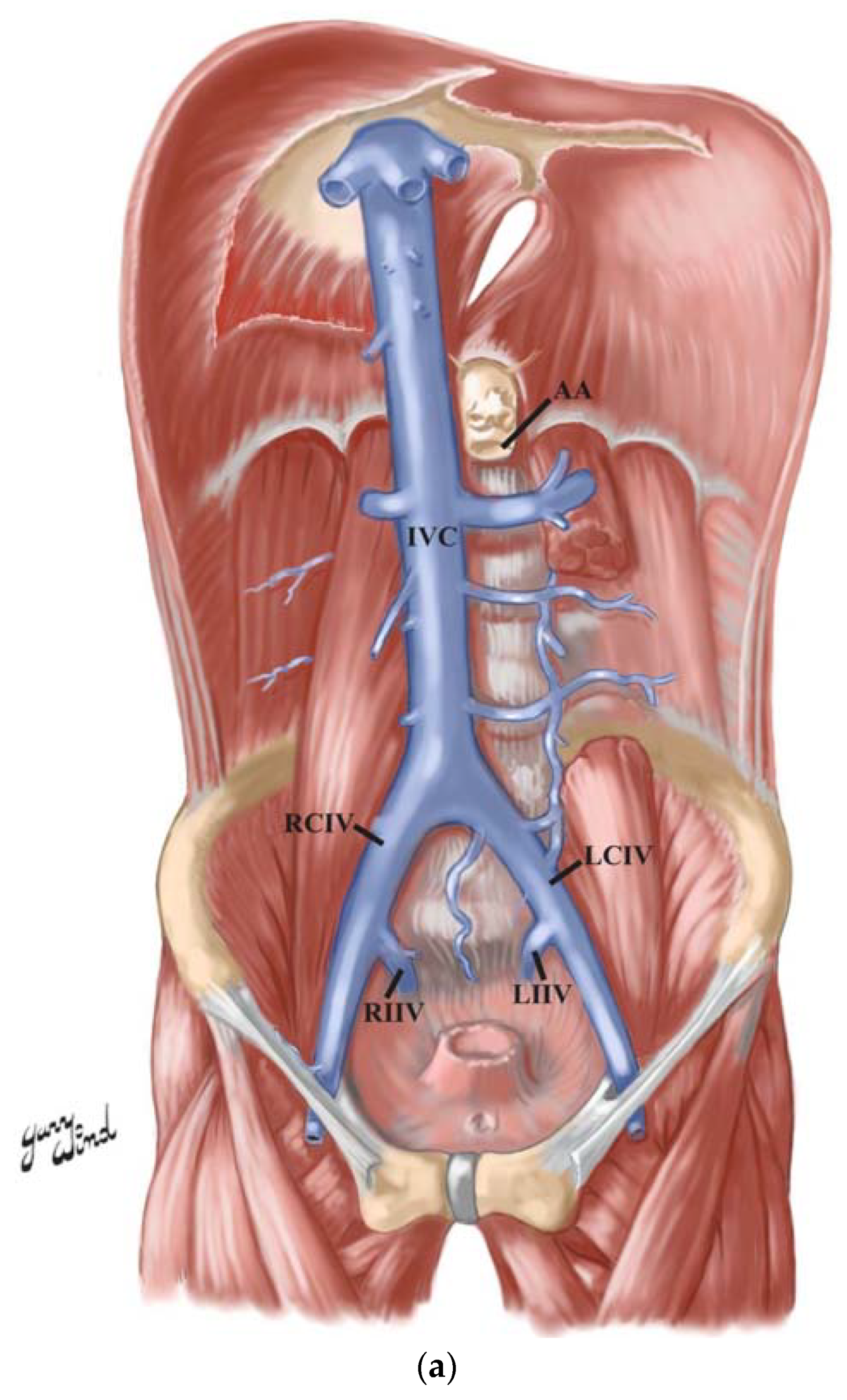 Vena Cavae anatomy Of The Superior Vena Cava And Inferior 52 OFF
