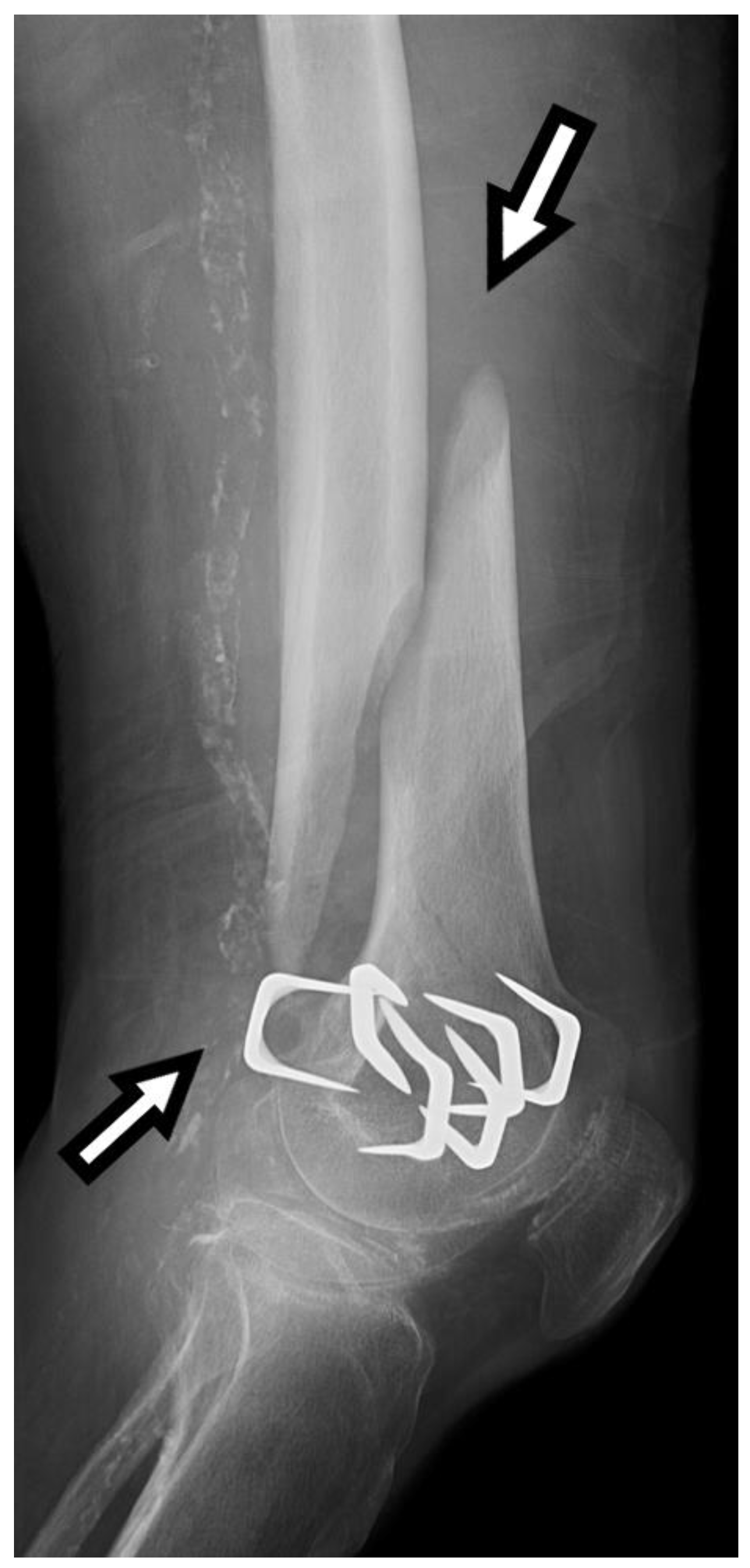 Lateral radiograph of the left tibia demonstrating the characteristic