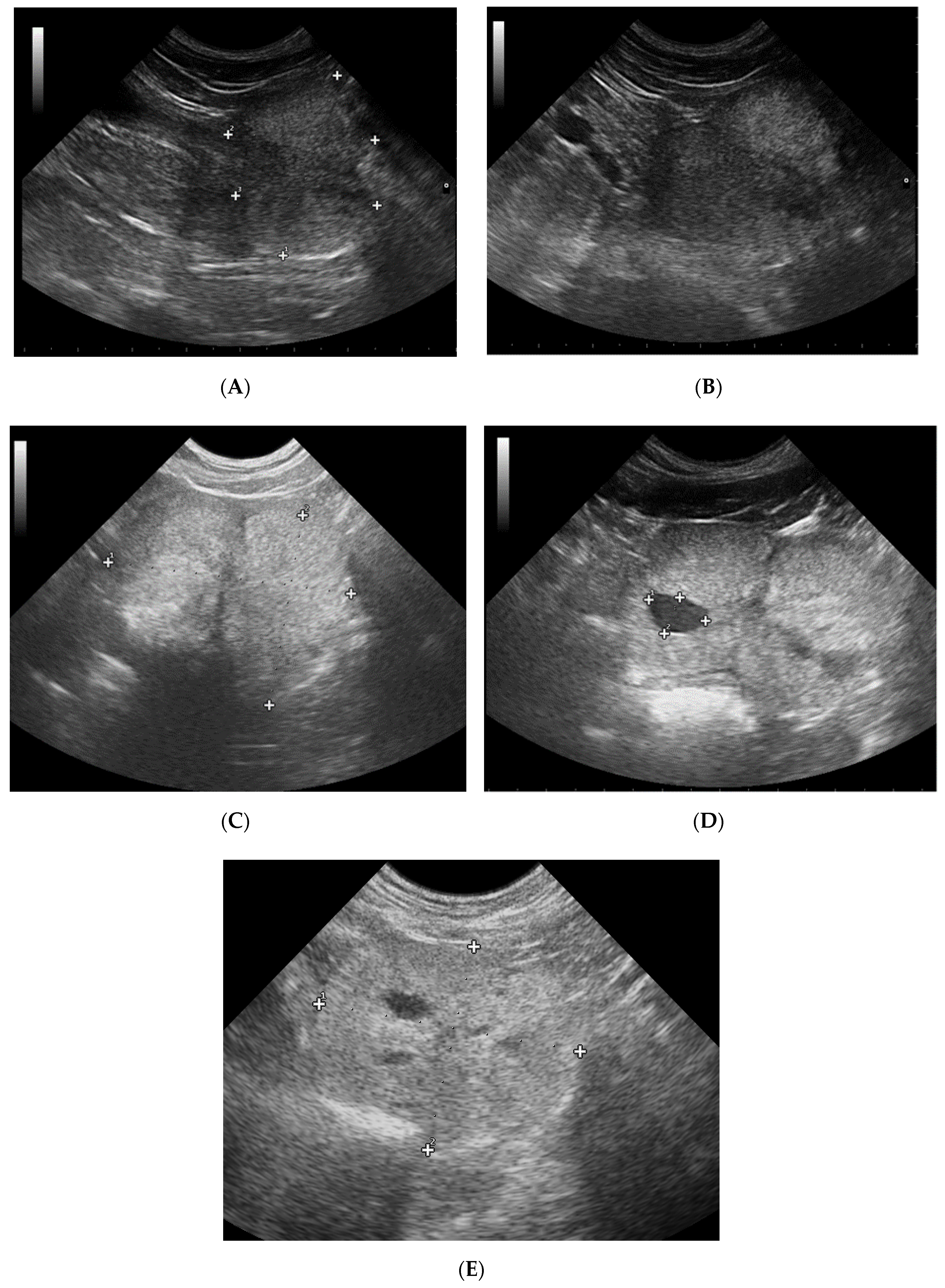 normal prostate volume cm3 ultrasound)