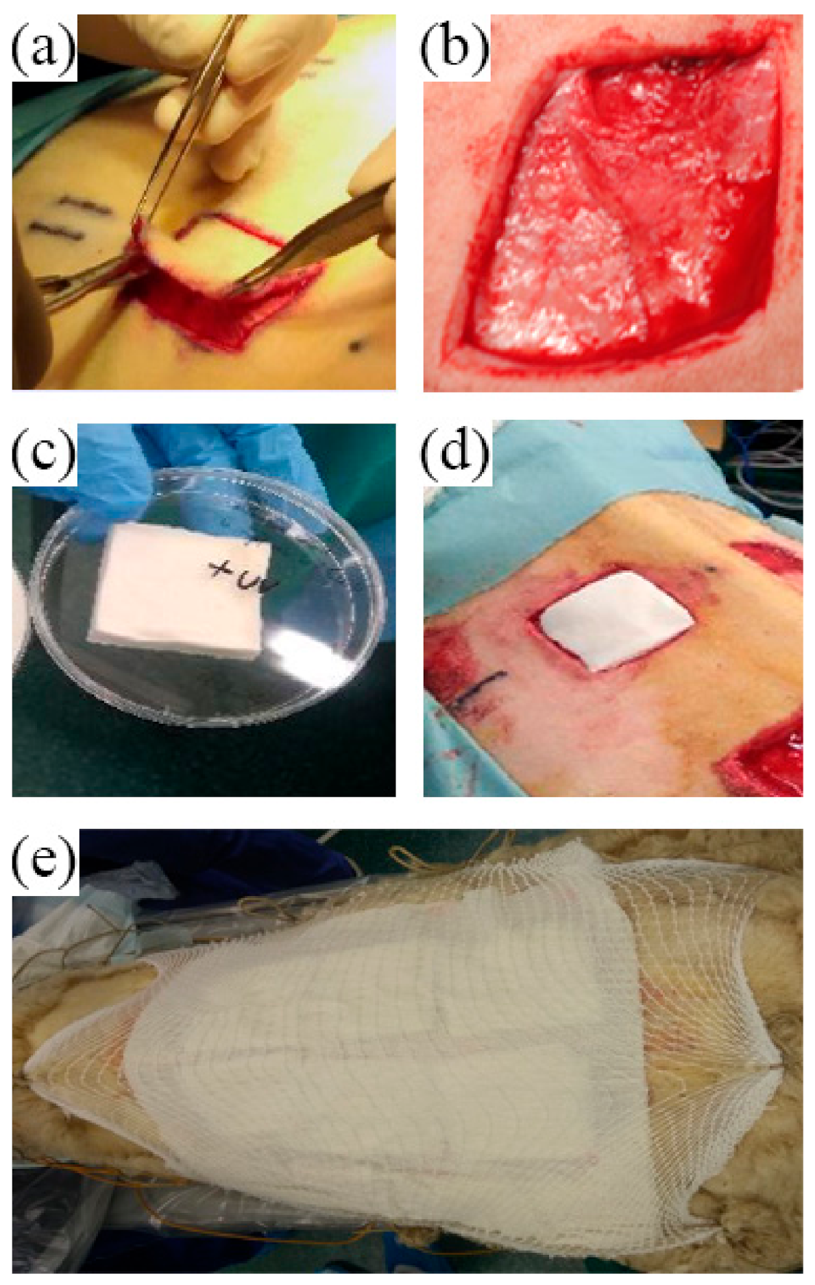 preposta resection