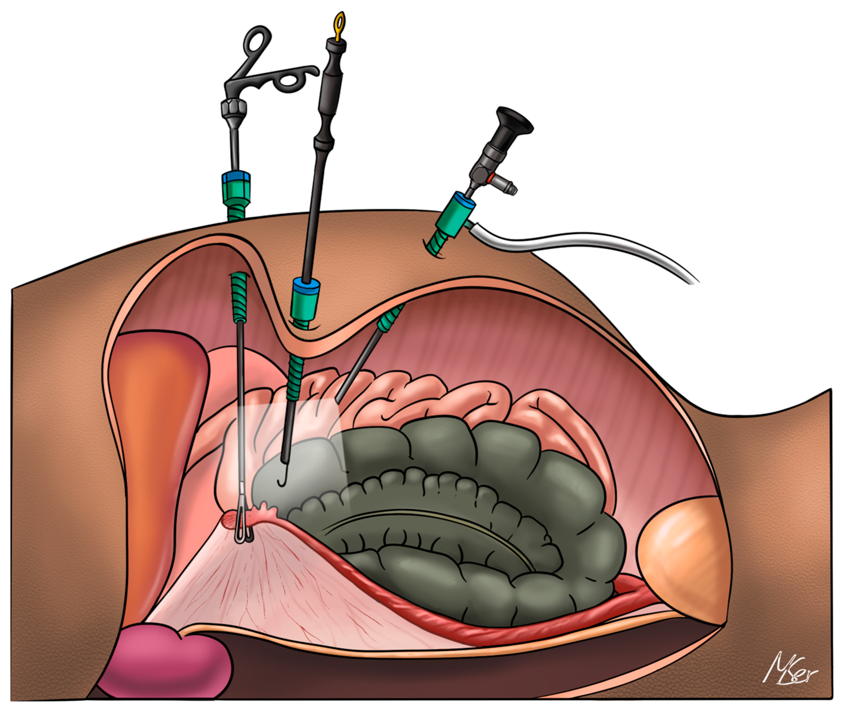 Ooforoplastia e salpingectomia laparoscópica / Oophoroplasty and  laparoscopic salpingectomy (left). 