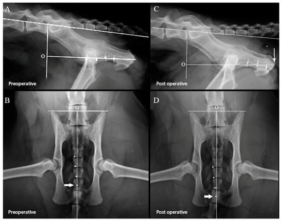 A Simple Combined Antegrade Radiological and Retrograde Endoscopic  Procedure to Recanalise Fibrotic Hypopharyngo-Oesophageal Occlusions:  Technical Description and Lessons from Clinical Outcome in Three Cases