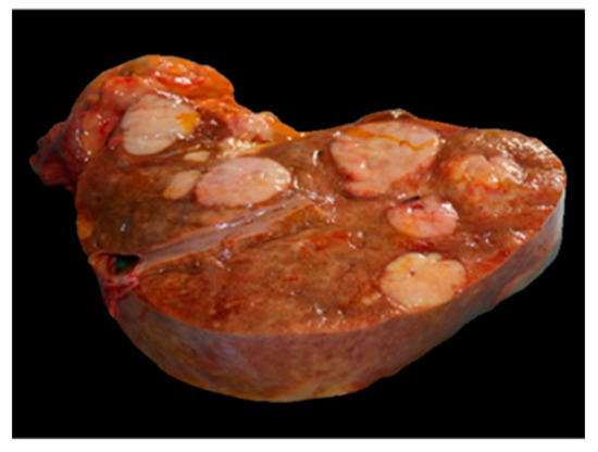 Histiocytic Sarcoma in a Captive Hybrid Orangutan (Pongo sp