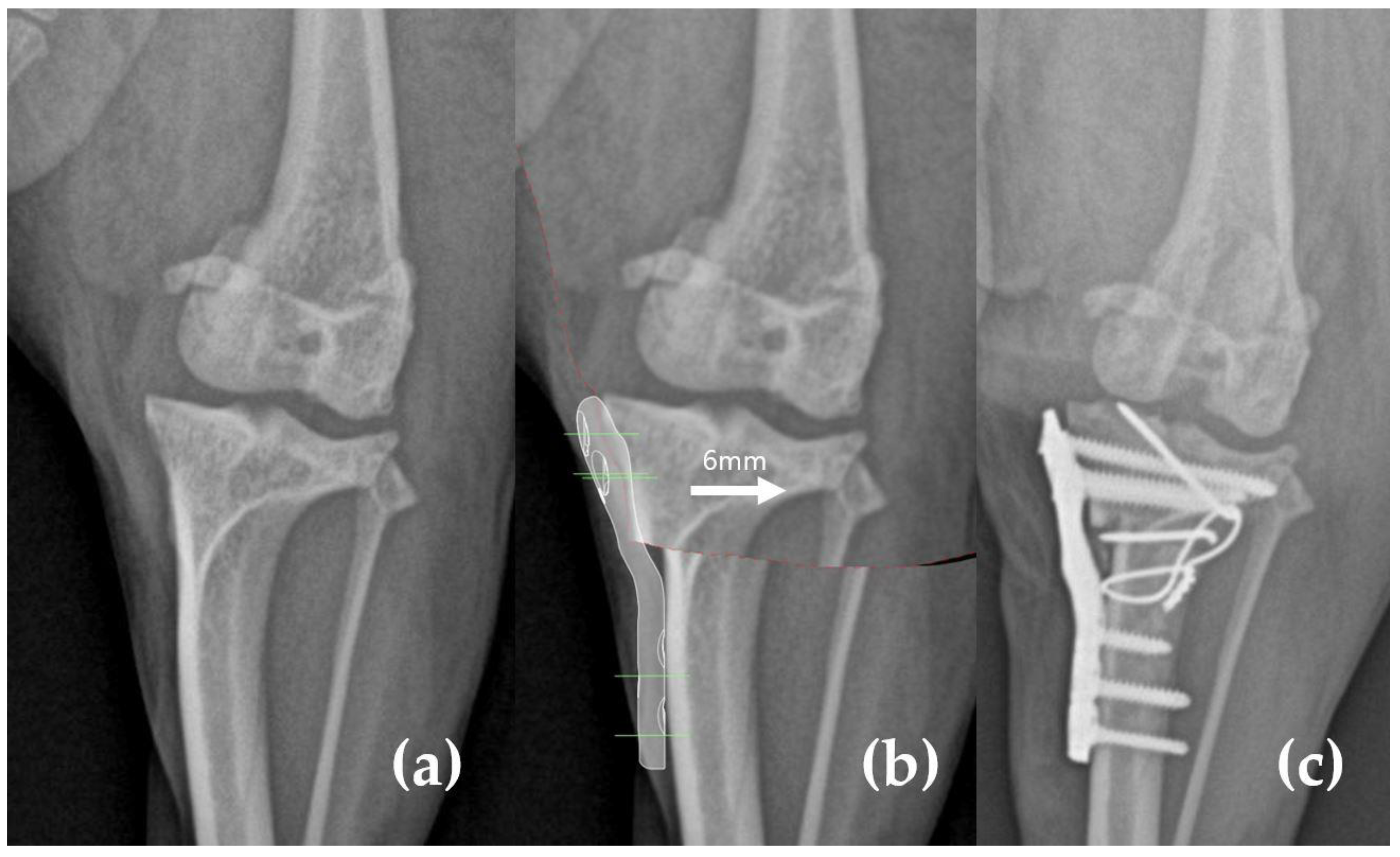 Simultaneous Modified Tibial Plateau Leveling Osteotomy and
