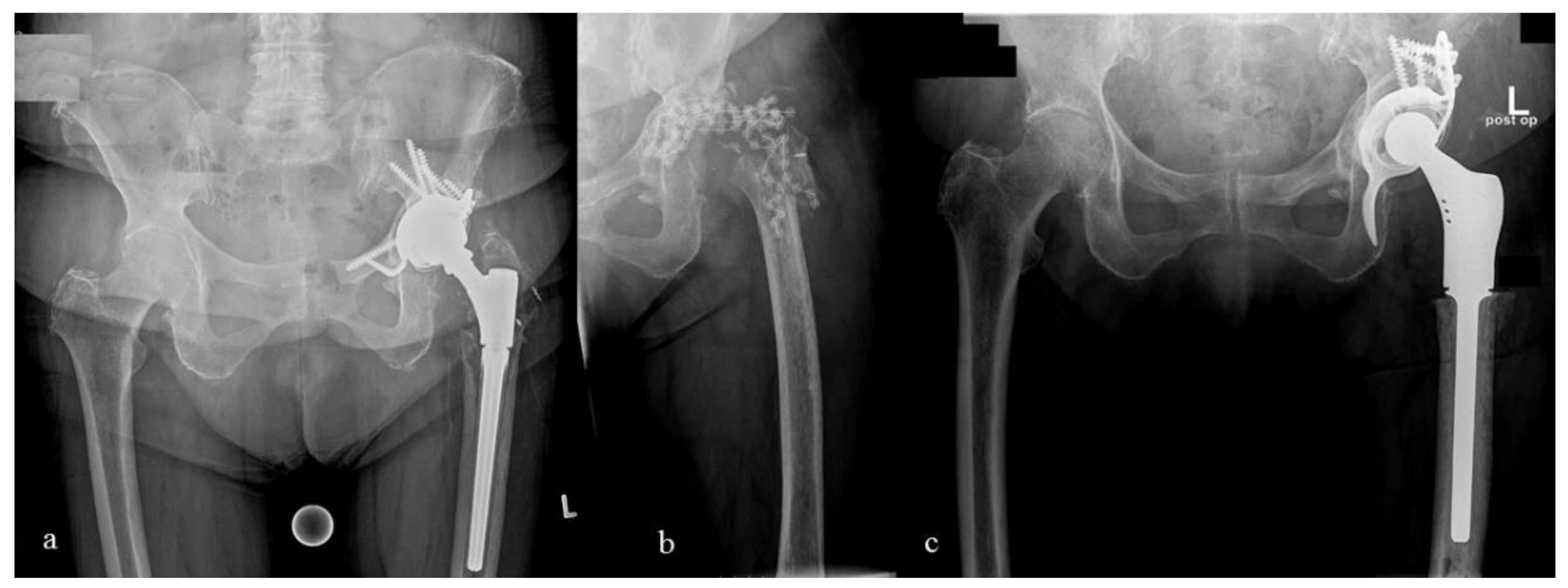 Antibiotics Free FullText Are Cement Spacers and Beads Loaded with