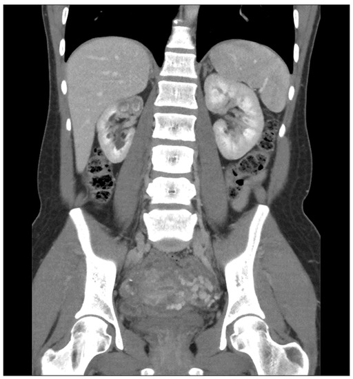 Antibiotics Free FullText Genitourinary Tuberculosis A