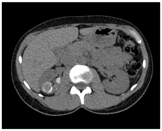 Tuberculosis - pulmonary manifestations | Radiology Case