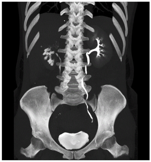 健康・医学 Tuberculosis The Population Dynamics and Control of Tuberculosis | Science