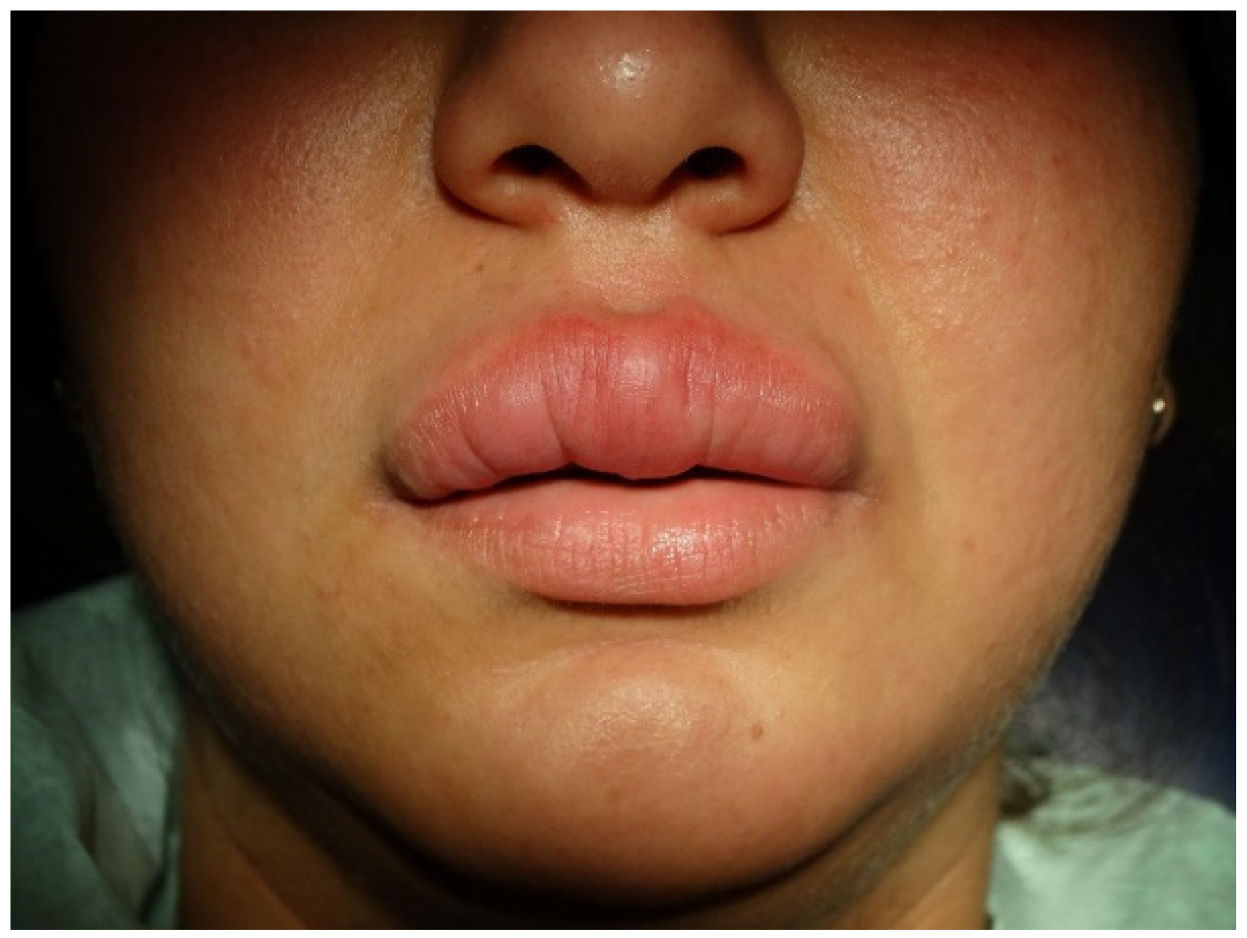 Antibiotics Free Full Text Granulomatous Cheilitis or Tuberculid