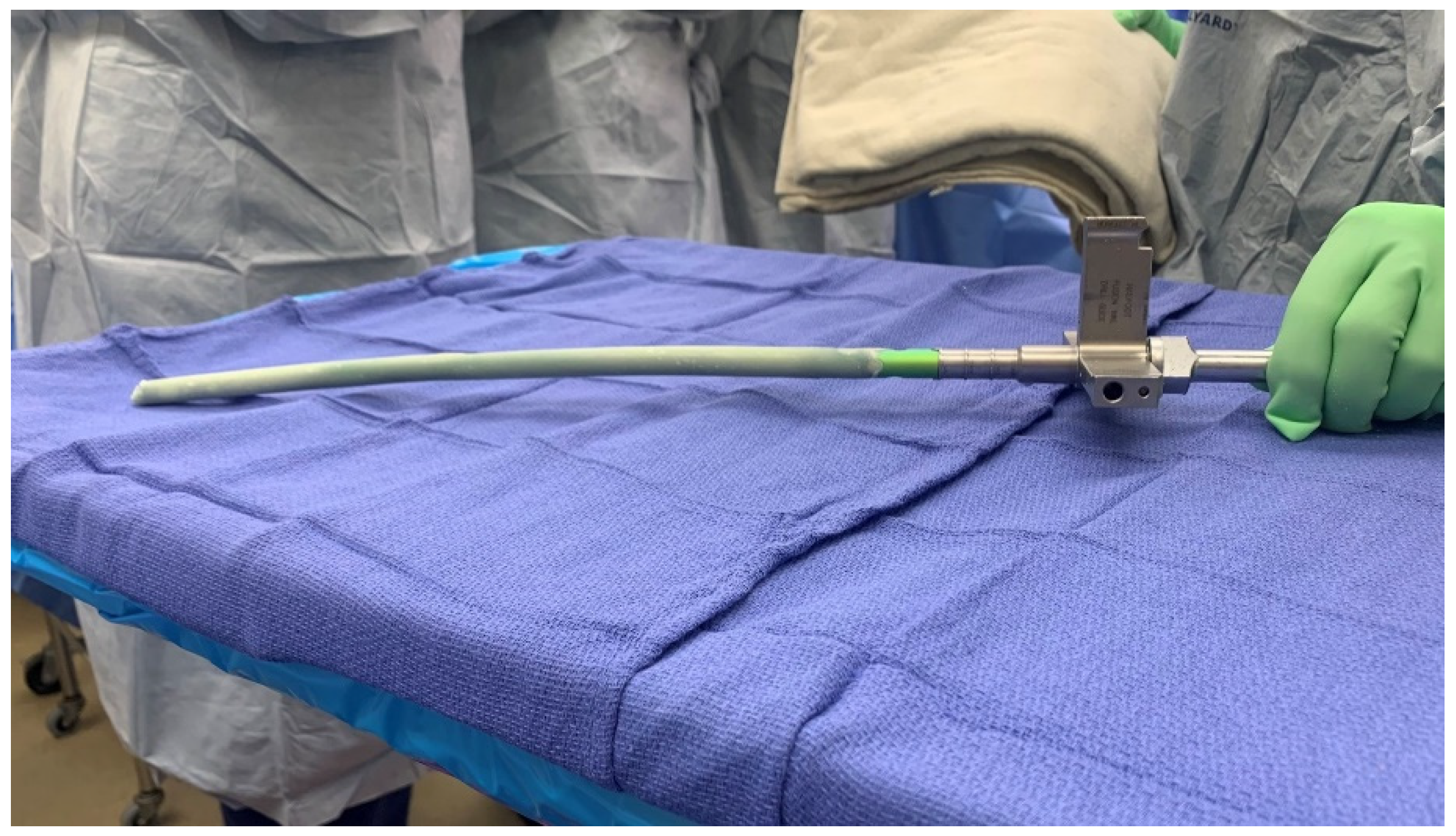 Use of antibiotic cementimpregnated intramedullary nail in treatment of  infected nonunion of long bones